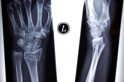 Decoding Long Covid: An Orthopaedic Explains How Prolonged Steroid Use, Bed Rest Can Damage Your Bones