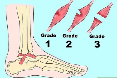 How to Treat a Sprained Ankle