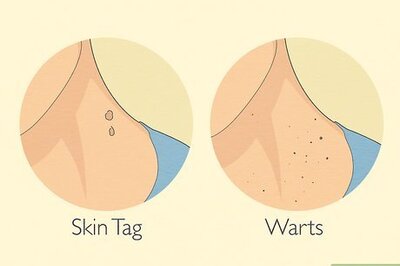 Get Rid of Skin Tags Safely: 12 Home Remedies & OTC Products