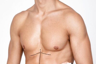 Liposuction: All You Need to Know About the Fat Removal Surgery