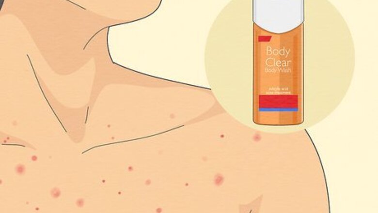 How to Get Rid of Acne on Your Chest at Home