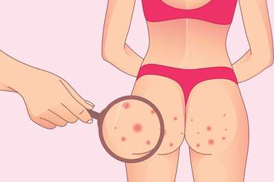 Butt Acne Can Affect Anyone, Home Remedies to Prevent it
