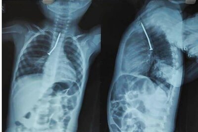 Doctors at SSKM Hospital Give Fresh Lease of Life to Two-Yr-Old Boy By Removing Iron Nail From His Trachea