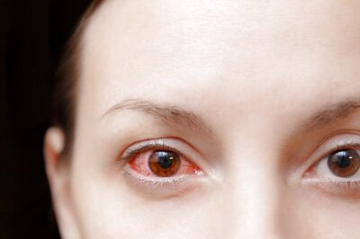 Conjunctivitis Cases on Rise: What Are Its Symptoms; Do Sunglasses Help | Know All About It