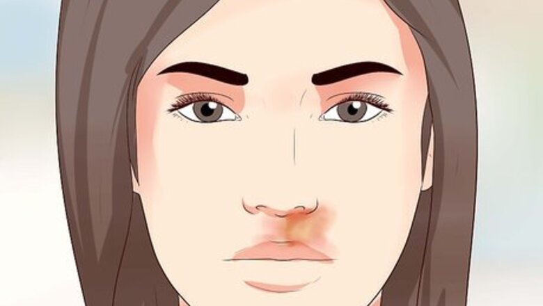 How to Cure Impetigo