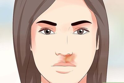 How to Cure Impetigo