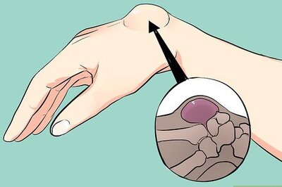 How to Treat a Ganglion Cyst
