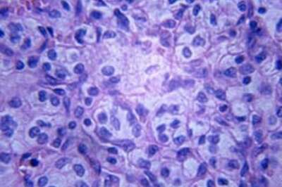 Lab disaster leads to new cancer drug