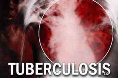 Drug resistance in TB has increased in India: Dr MS Kanwar