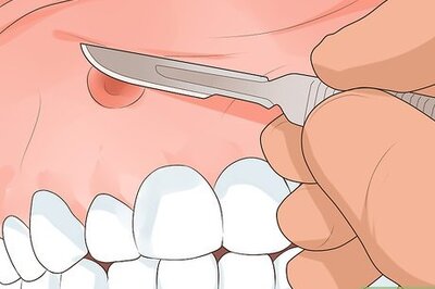How to Get Rid of a Gum Boil
