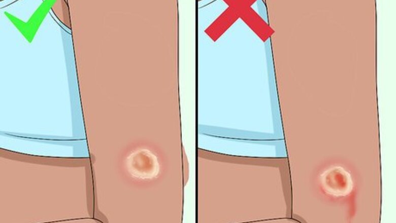 How to Get Rid of a Scab
