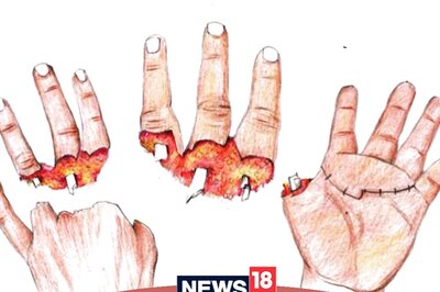 How Long Can An Amputated Body Part Be Preserved For Replantation? Expert Answers