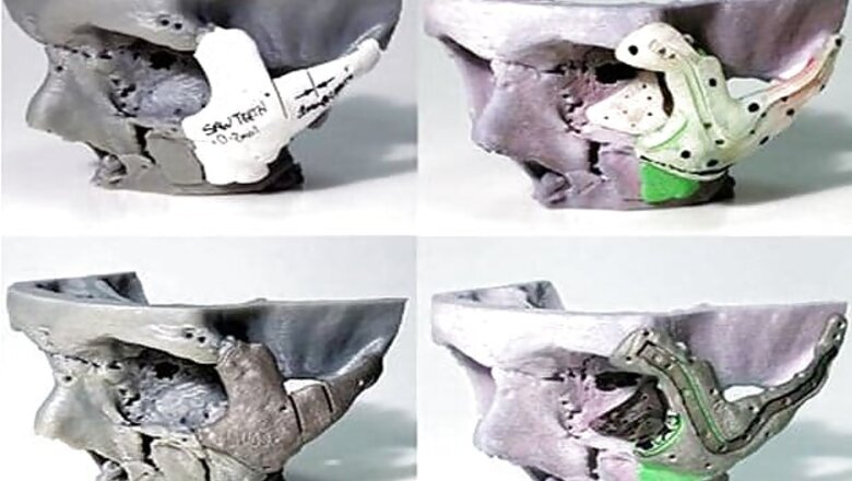 Doctors use 3D printing to reshape accident victim's face