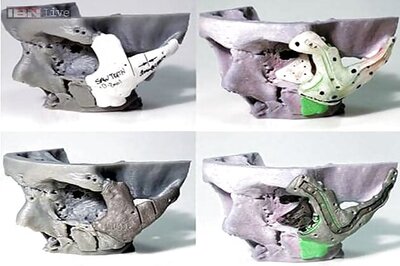 Doctors use 3D printing to reshape accident victim's face