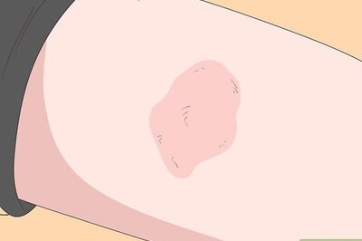 How to Know What Degree a Burn Is