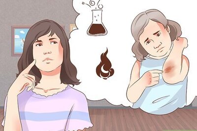 How to Treat Burns in Children