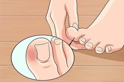 How to Cure an Infected Toe