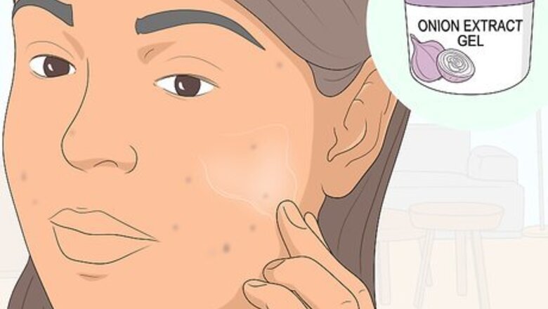 How to Get Rid of Acne Scars: Can Natural Remedies Help?