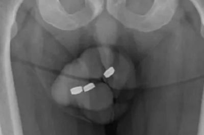 Charged Attempt at Pleasure Fails: Batteries Man Shoved Up His Penis Get Stuck, Leading to Necrosis