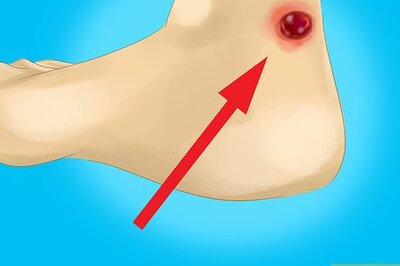 How to Treat Raw Blisters on the Palm of Your Hand