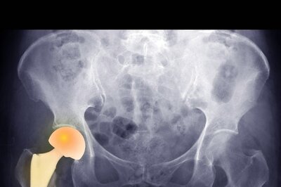 Learn More About Total Hip Arthroplasty and the Function of Robotics in THA