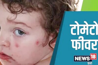 What Is Tomato Flu? Symptoms, Causes And Preventions