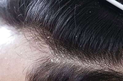 How Deficiency Of These Vitamins Causes Dandruff And Other Hair Problems