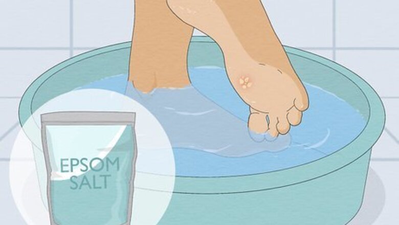 How to Get Rid of a Wart at the Bottom of Your Foot