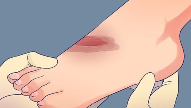 How to Treat Deep Cuts