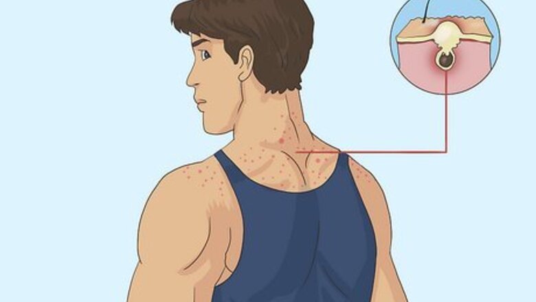 How to Tell If Someone Is on Steroids (With Pictures)