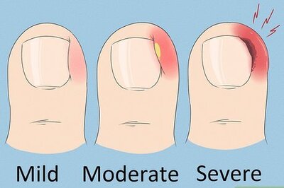 Will an Ingrown Toenail Heal Itself? Your Top Ingrown Toenail FAQ Answered